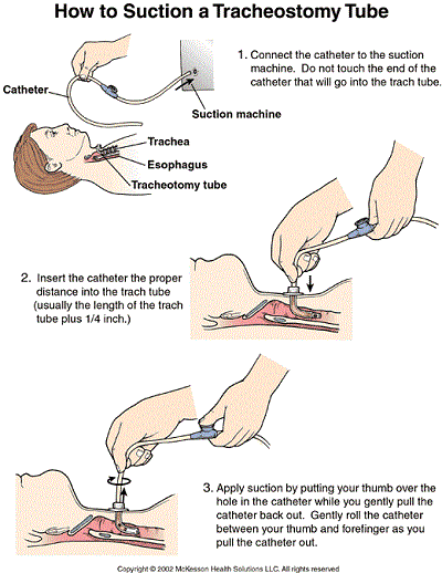 tracheostomy care