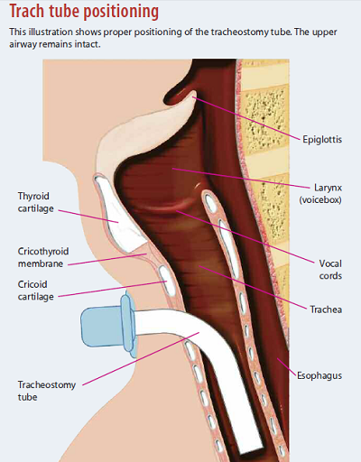 trach tube positioning