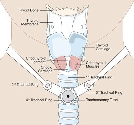 tracheostomy positioning